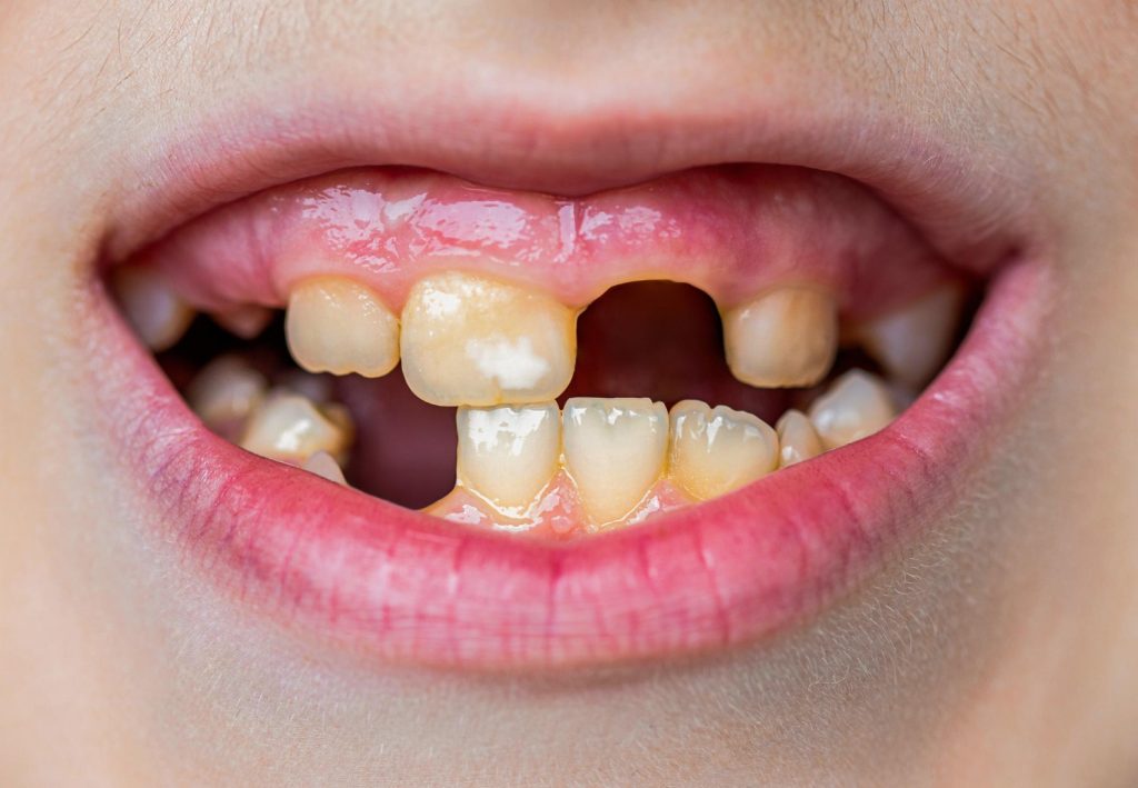 10 mauvaises habitudes qui nuisent à la santé de vos dents