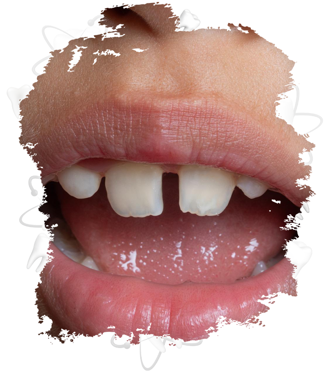 Diastema (Ayrık Diş) Tedavisi Nasıl Yapılır