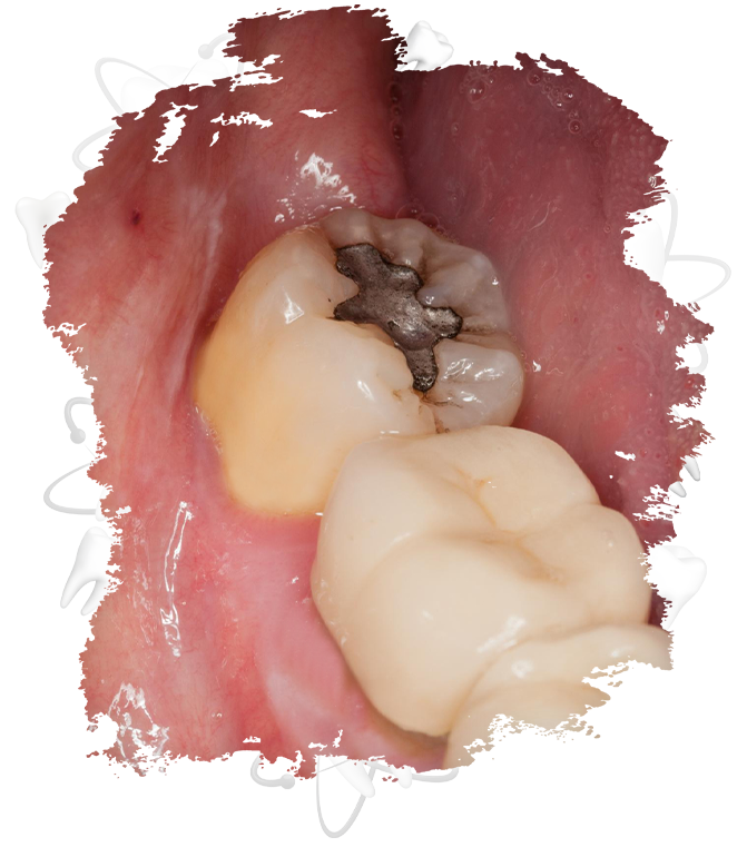 Amalgam Dolgu Nedir? Niçin Tercih Edilir?